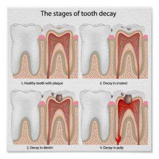 Tooth decay Poster