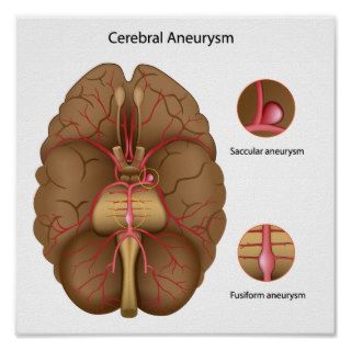 Cerebral aneurysm Poster