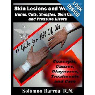 Skin Lesions and Wounds Burns, Cuts, Shingles, Skin Cancer and Pressure Ulcer ( Concepts, Causes, Diagnoses, Treatment and Care ) Solomon Barroa 9781482080407 Books