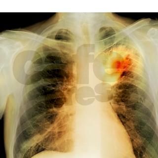 Lung abscess, X ray Square Keychain by Admin_CP66866535