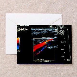 Doppler ultrasound scan of carotid artery stenosis by sciencephotos