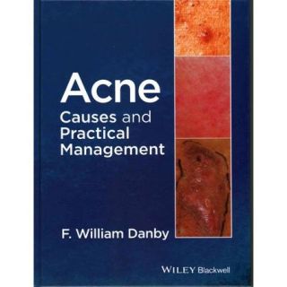 Acne Causes and Practical Management